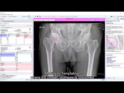 How to Plan a Total Hip Arthroplasty (THA) in Less than 60 Seconds | Materialise OrthoView