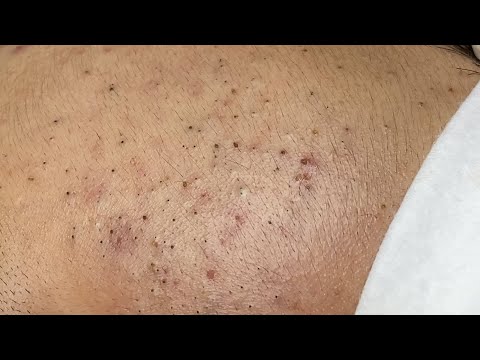 How to Remove Blackheads