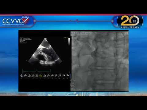 Live Case 8 - SAPIEN-3 TAVR with Sentinel Device - CCVVC 2017