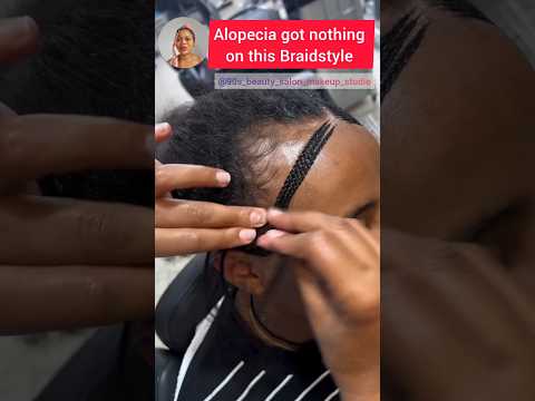 Braid artistry, even without hair you can get this cute braidstyle - Alopecia braids