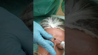 Como rellenar frente,entrecejo con Acido Hialuronico Sin aguja con Hyaluron pen