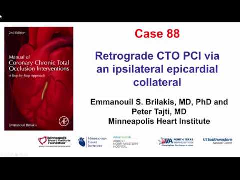 Case 88: Manual of CTO Interventions: Retrograde via ipsilateral epicardial collateral