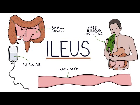 Understanding Ileus (Paralytic Ileus)