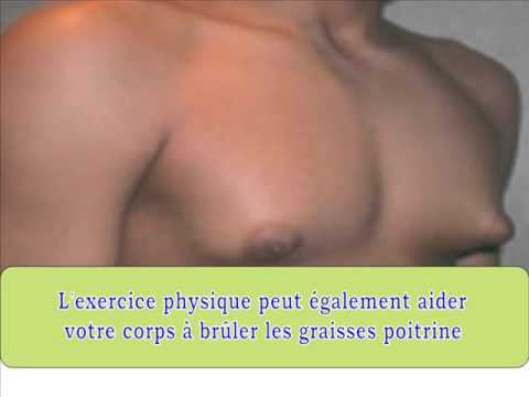 comment soigner varicocele