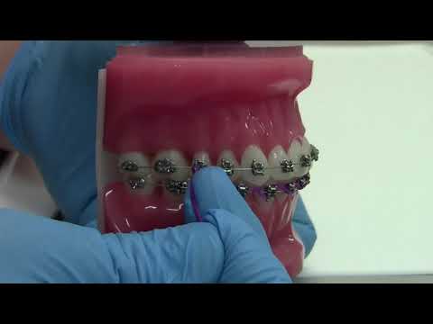 Broken or detached Power Chain (Orthodontic emergency)