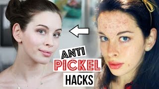 Beste ANTI PICKEL HACKS: PICKEL über NACHT WEG, DIY Pickelmale AUFHELLEN | LIVE TEST unreine Haut