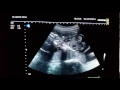 hydrops fetalis ultrasound