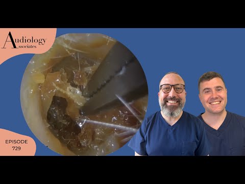 HARDENED SKIN REMOVAL FROM EAR - EP729