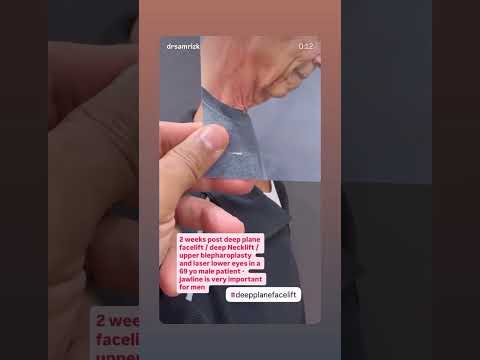 Male Facelift & Neck Lift: 2-Week Recovery | Dr. Rizk