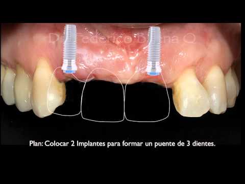 Implantes Dentales en Querétaro