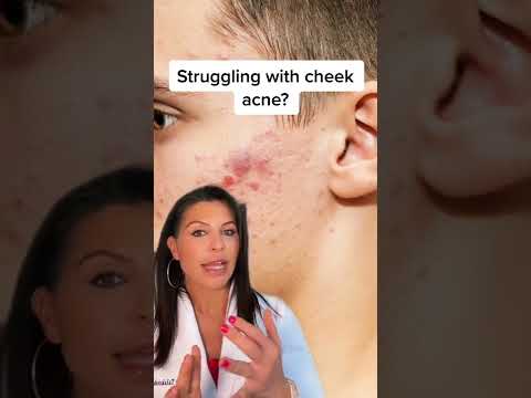Struggling with cheek acne? || #shorts