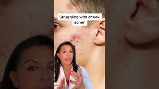 Struggling with cheek acne? || #shorts