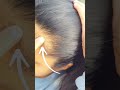 3 Tips That Can Fix Your RECEDING HAIRLINE Receding Hairline TRANSFORMATION