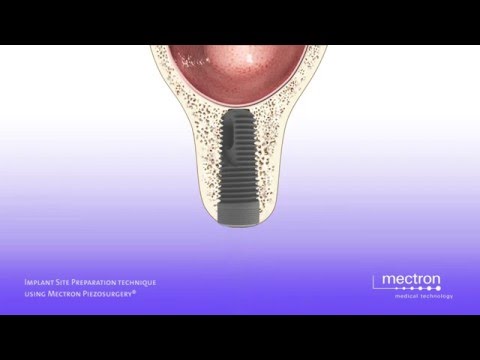 PIEZOSURGERY® - ultrasonic implant site preparation (animation)
