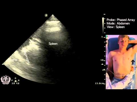 Abdominal Ultrasound of the Spleen (Basic Video)