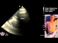 Abdominal Ultrasound Of The Spleen Basic Video
