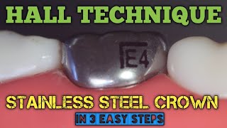 Hall Technique for Stainless Steel Crown | 3 Easy Steps