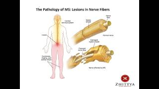 Revolutionary Treatment for Women’s Heart Disease and Multiple Sclerosis