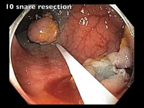 Pólipo grande y sésil localizado en el colon transverso