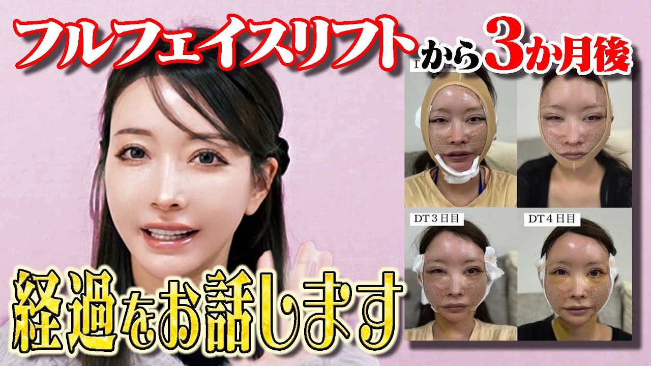 【経過】フルフェイスリフトから3か月後の報告をします！