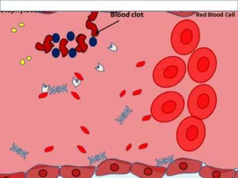 Illuminato indietro a causa di malattia degenerativa del disco Comprare vitamine per le ossa e le articolazioni