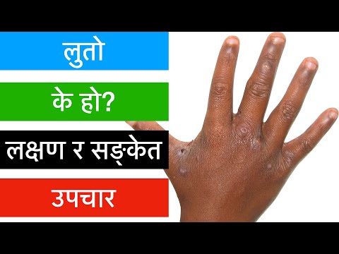 Luto/Scabies(In Nepali)/luto FALNE/लुतो के हो?लक्षण र सङ्केत /उपचार