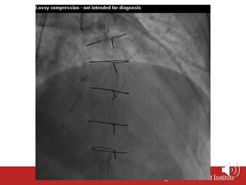 Complex Retrograde Ostial RCA CTO