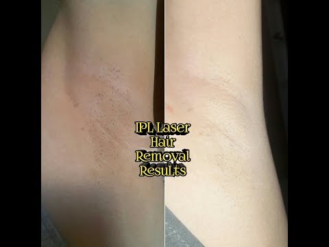 IPL laser Hair removal First Session