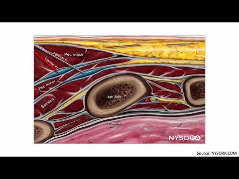 PECS I vs. PECS II Blocks by Isaac Hunter, MD Candidate Class of 2023