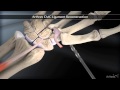 Arthrex CMC Ligament Reconstruction