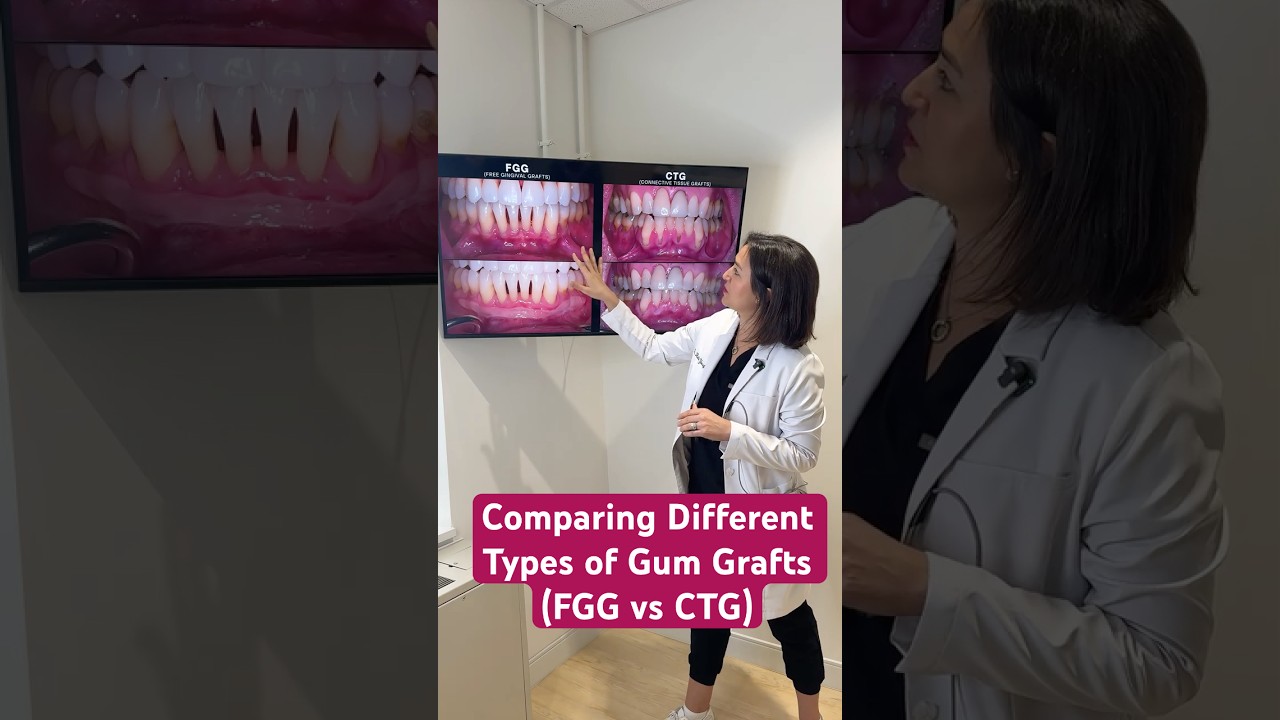 Comparing Different Types of Gum Grafts #gumgraft #gumrecession #periodontist #washingtondc #dentist