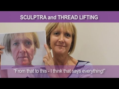 Debbie Sculptra Collagen Injections testimonial on Sculptra and Silhouette Soft thread