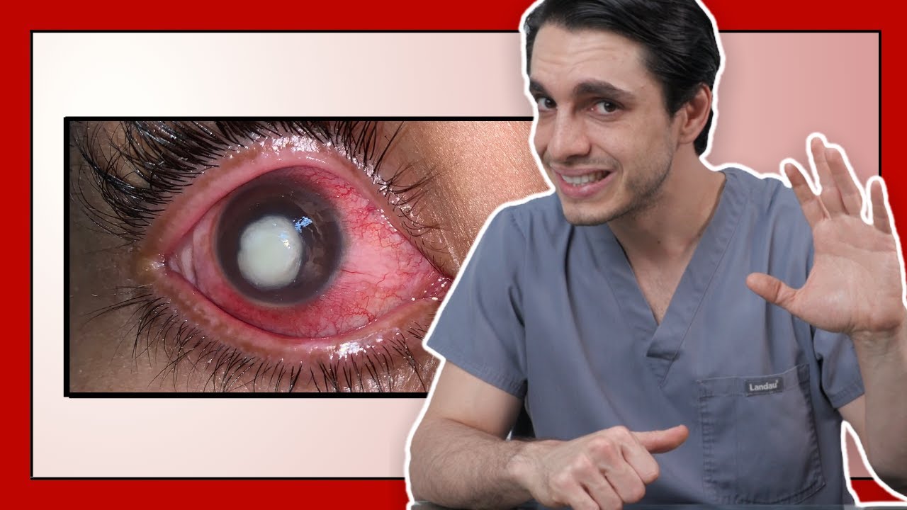 Watch 3 ERRORES que JAMÁS debes cometer con Lentes de Contacto ⚠️ EVITAR INFECCIONES es Simple Now 3 ERRORES que JAMÁS debes cometer con Lentes de Contacto ⚠️ EVITAR INFECCIONES es Simple