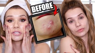 HOW TO INSTANTLY GET RID OF ACNE OVERNIGHT (ACTUALLY WORKS!)