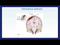 Neurología - Hematoma