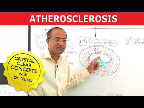 Hipertóniás atheroclephitis, A lábak erek szklerózisa - Szívizomgyulladás