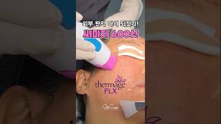 써마지 성형 시술