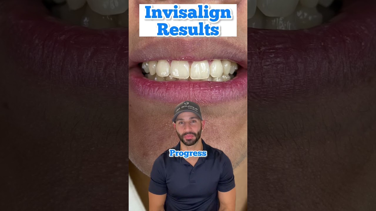 How does Invisalign work? Here’s a behind the scenes…
