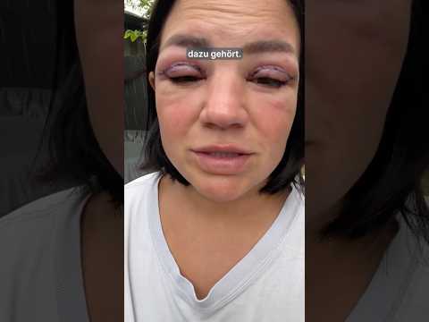 Oberlidstraffung – mehr als nur Hautentfernung! doc.rolf reacts