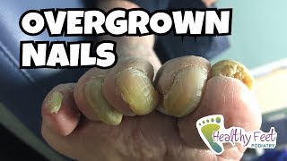 Overgrown Toe Nails | Healthy Feet Podiatry of Tampa and Wesley Chapel
