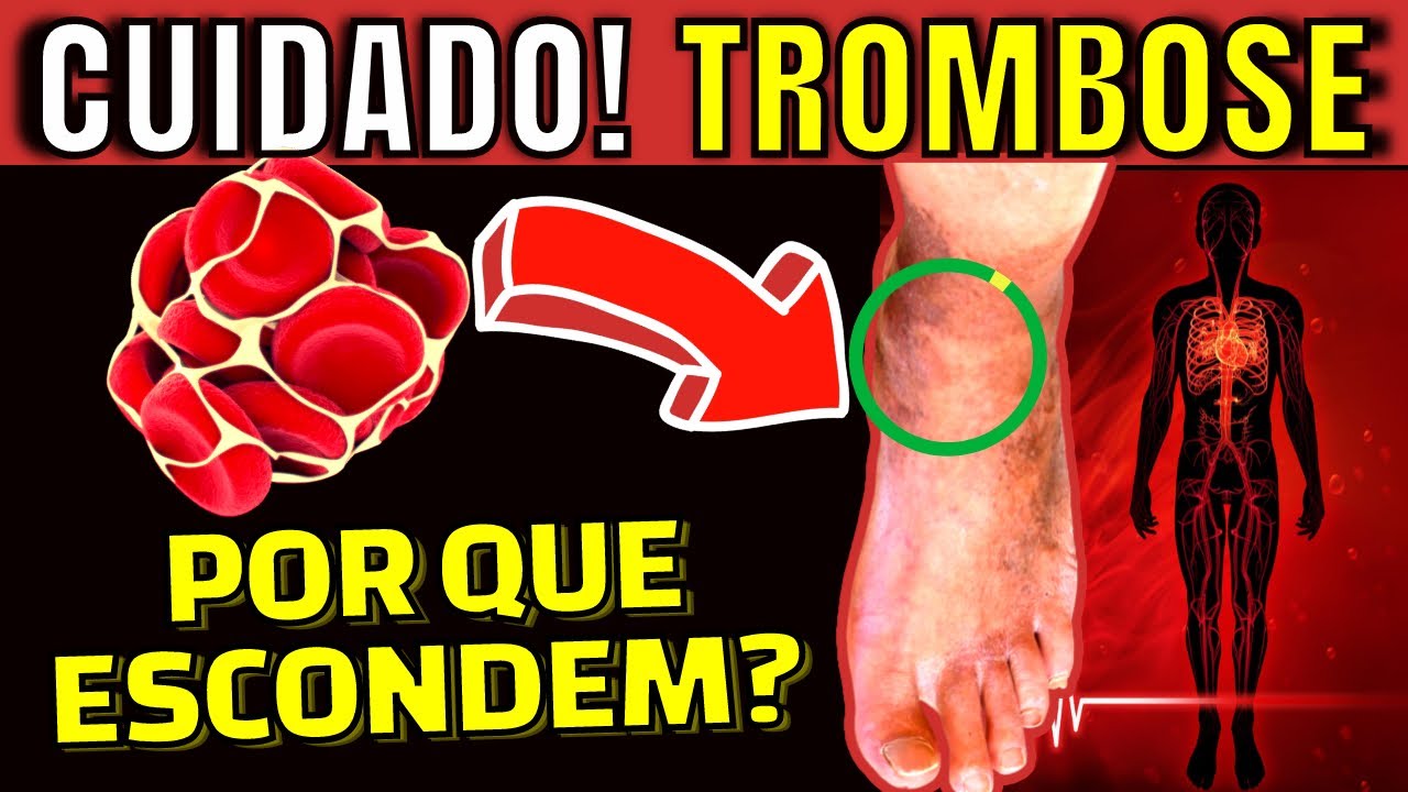 7 Proven Ways to PREVENT THROMBOSIS in the LEGS and IMPROVE poor BLOOD CIRCULATION