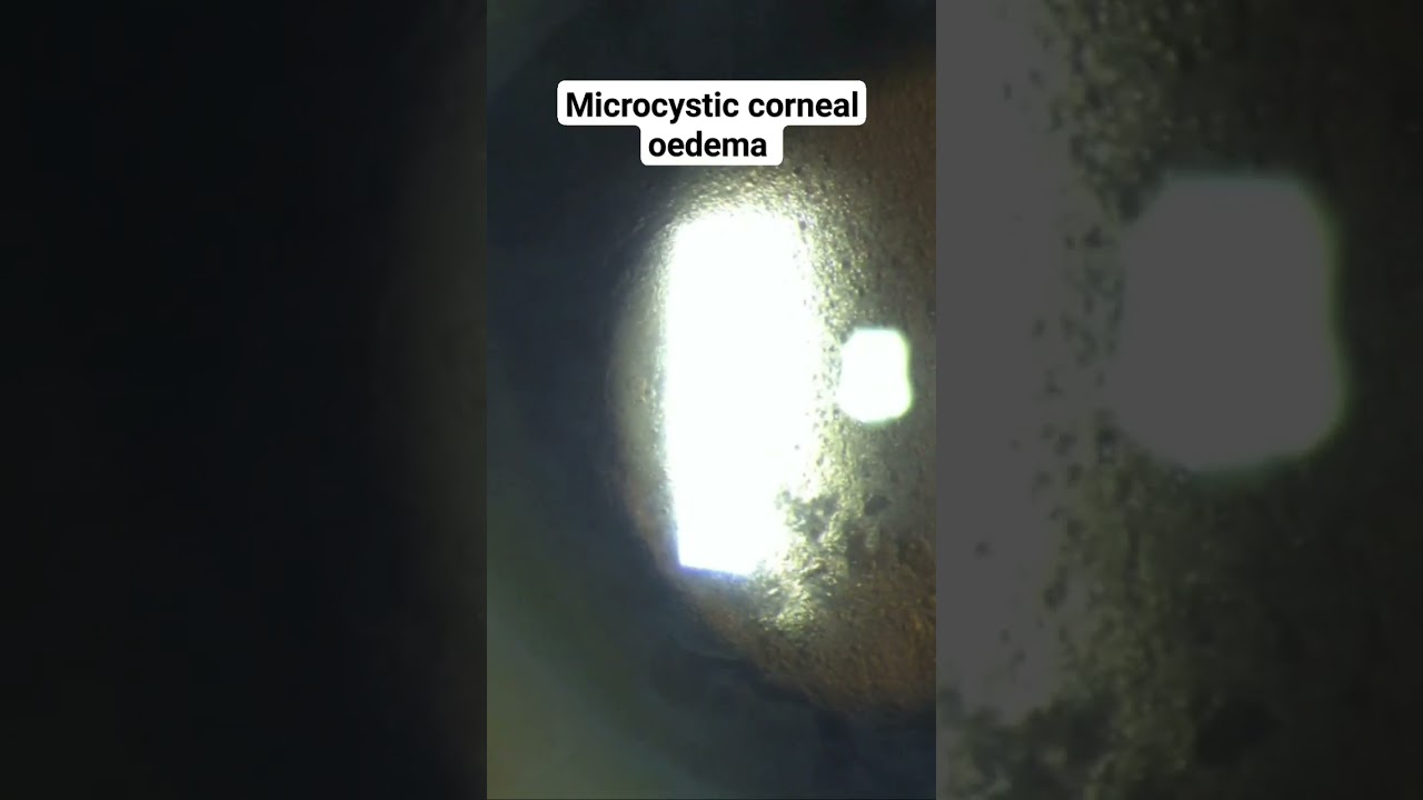 microcystic corneal oedema