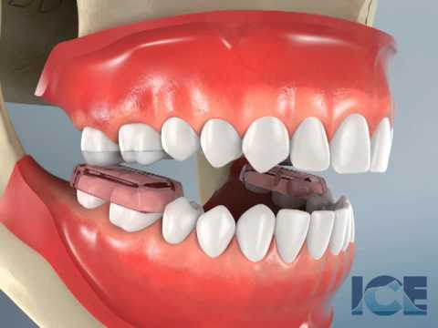 Anterior Openbite (bite block)