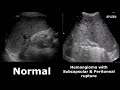 Spleen Ultrasound Normal Vs Abnormal Image Appearances Comparison Splenic Pathologies Ultrasound
