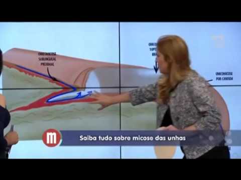 Clinica Martinez - Micose de unha - Mulheres - 19/05/2015