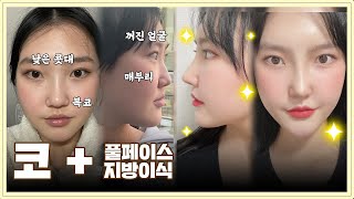[코성형후기]  기능과 미용 둘 다 잡은 코성형 + 풀페이스지방이식??