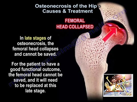 Osteonecrosis Of The Hip Causes & Treatment - Everything You Need To Know - Dr. Nabil Ebraheim