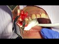 How To Remove Broken To Gum-Line Upper Molar