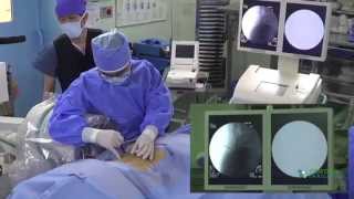 Treatment for Degenerative, Bulging and Herniated Discs Minimally Invasive Stem Cell Therapy