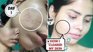 HOW I CLEARED MY TEXTURED, IRRITATED SKIN IN JUST 7 DAYS | 7 Days  Challenge